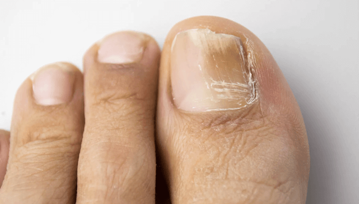 Gljivice na noktima i nogama